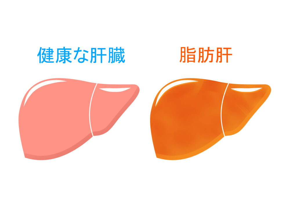 脂肪肝とは