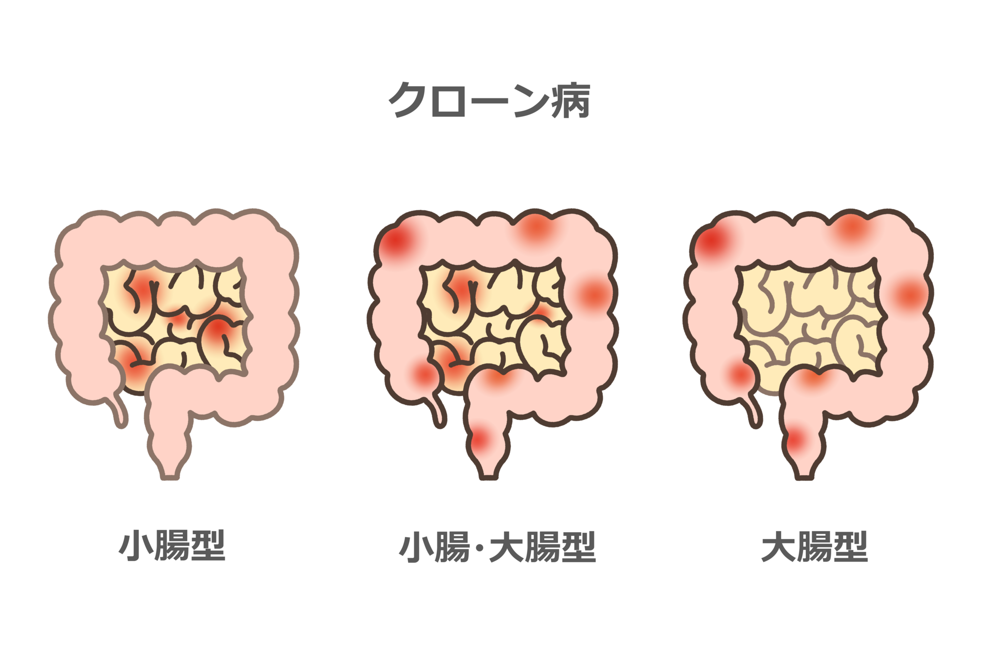 クローン病